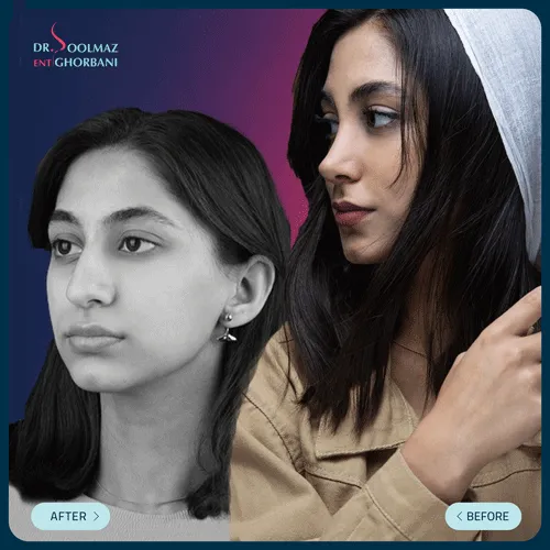 عکس قبل و بعد از عمل بینی دخترانه نیمه فانتزی توسط دکتر سولماز قربانی