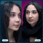 نتیجه جراحی بینی نیمه فانتزی ظریف